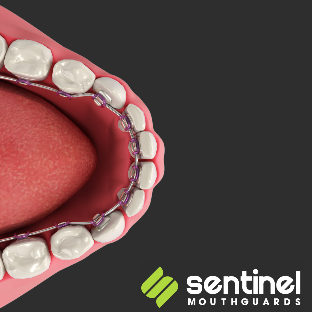 wearing a night guard with a lingual retainer|permanent bar or lingual retainer to keep teeth from shifting