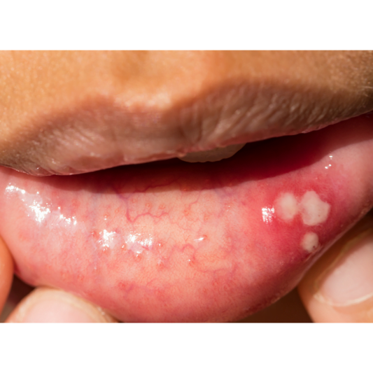 canker sores