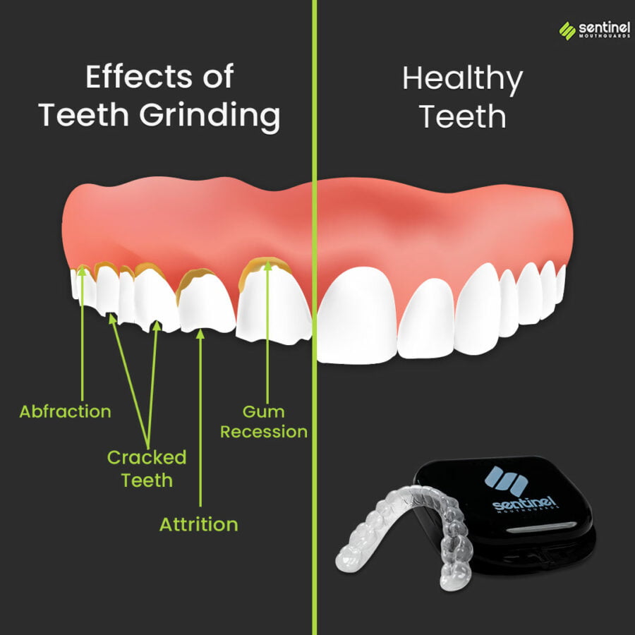 example of damage from teeth grinding and jaw clenching