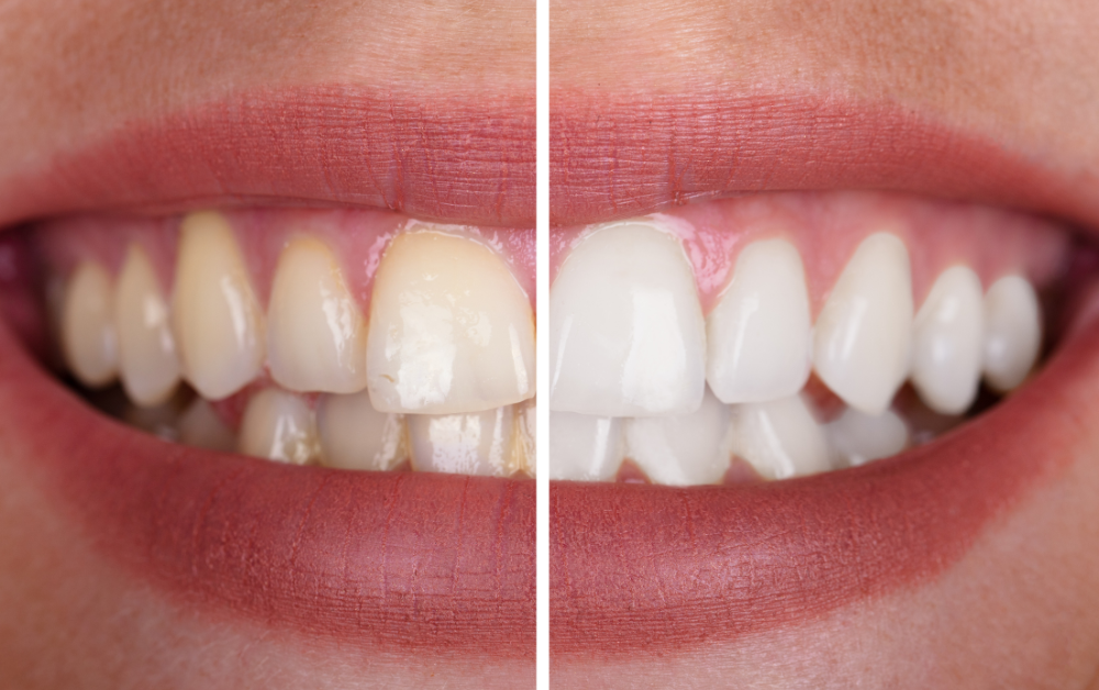 how to get rid of yellow teeth
