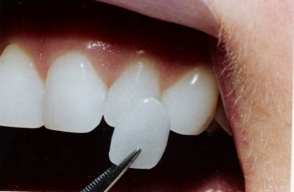 night guard for veneers